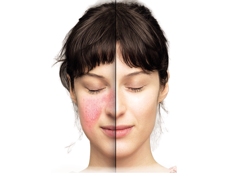Rosacea Treatment
